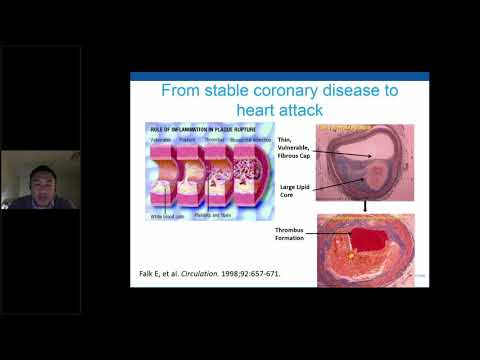 Cardiovascular Disease in Prostate Cancer
