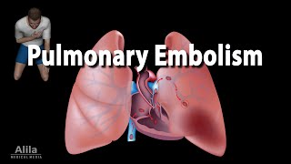 Pulmonary Embolism, Animation