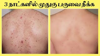 how to cure back acne at home in tamil | Back acne removal method | be you deserve
