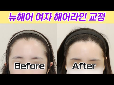 여자 헤어라인 교정 1200모낭(2400모) 360일 경과 I 뉴헤어 I Before&After