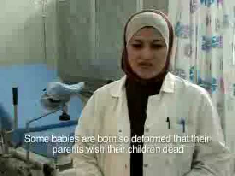 Fallujah Iraq Baby Deformities Caused by American Chemical Attacks