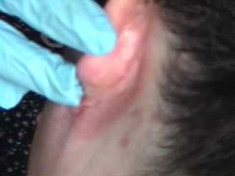comment guerir un mal d'oreille