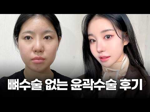 다이어트해도 안 빠지는 턱살, 수술 한 번으로 완벽하게 삭제한 1년 차 후기ㅣ디에이성형외과ㅣ연조직윤곽술