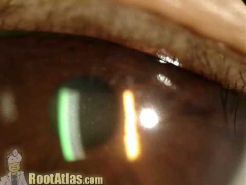Cells & flare in the anterior chamber
