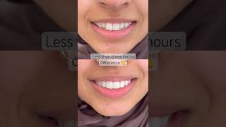Composite bonding on four teeth only! 🙌 #compositeveneer #compositebonding
