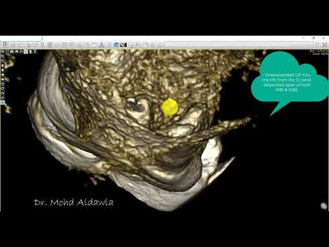 Overextended GP into Maxillary Sinus