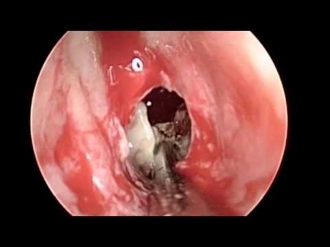 Balloon Plastic Surgery of Sphenoid Sinus