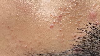 Soothing Facial Treatment for Acne-Prone Skin 648 P6