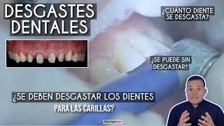 ¿Se deben desgastar los dientes para las carillas 🤔 ¿Se hace en todos los casos- Odontología Láser