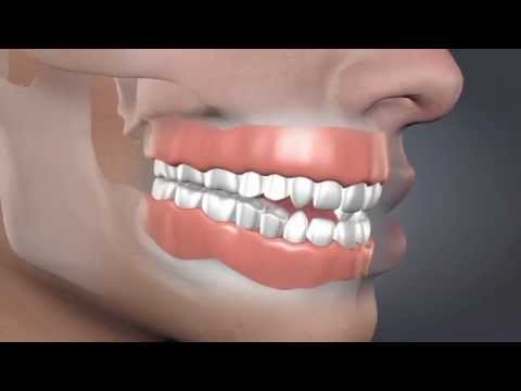 Devastating Consequences of Tooth Loss- Bone Loss Visual