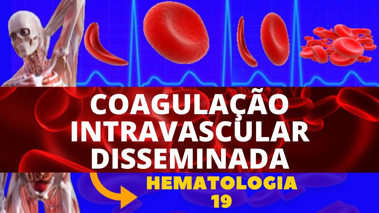 COAGULAÇÃO INTRAVASCULAR DISSEMINADA (CIVD) - HEMATOLOGIA