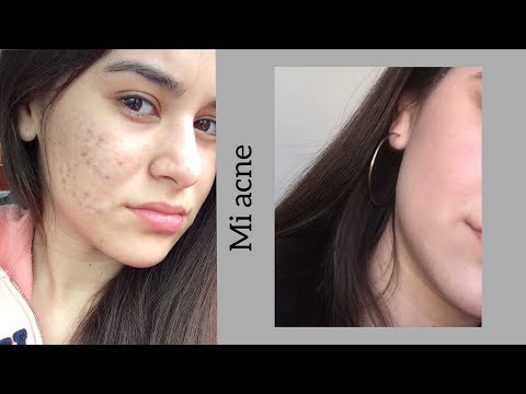 download lagu mp3 mp4 Acne Estres, download lagu Acne Estres gratis, unduh video klip Acne Estres