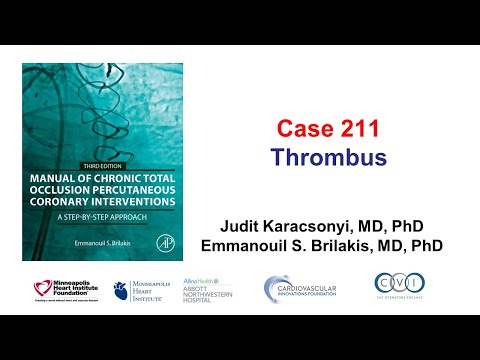 Case 211: Manual of CTO PCI - Thrombus