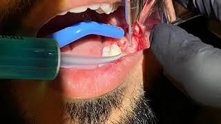 Surgical Wisdom Tooth Extraction (LL8) by Specialist Oral Surgeon Dr. Abdul Dalghous