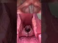 Live View Of The Vocal Cords Anatomy Medical Funfacts