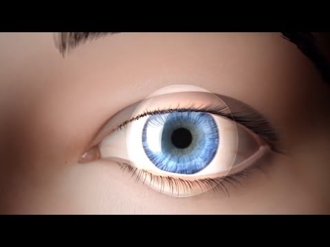 Photorefractive keratectomy (PRK)