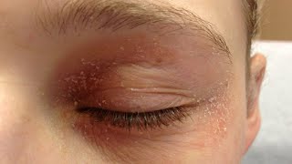 how to get rid of eczema on eyelids naturally