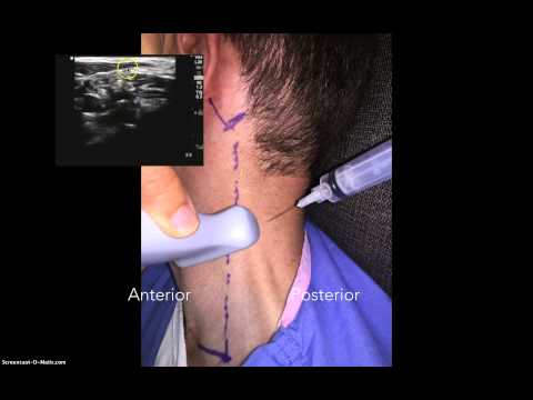 Cevical Plexus Nerve Block