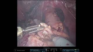 Deep Pelvic Floor Endo AND Rectal Disc Excision - DOUBLE FEATURE!!