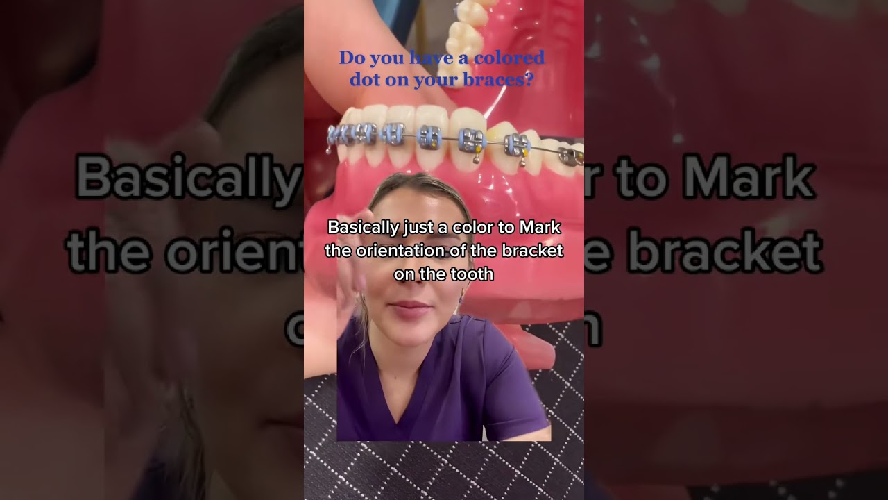 #greenscreenvideo The colored dots just help us doctors out!! #braces #bracestips #bracesguide