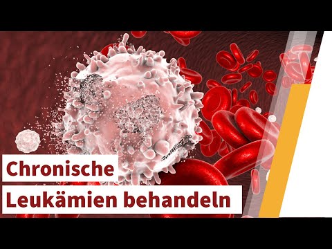 Chronische Leukämien: Ursachen, Symptome und Behandlung