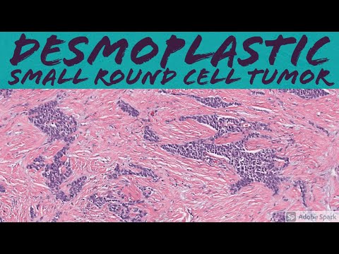 Desmoplastic Small Round Cell Tumor: 5-Minute Pathology Pearls