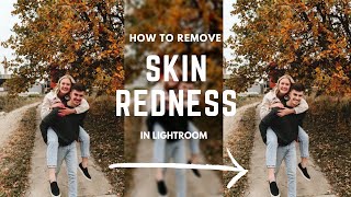 How to Remove Red Skin Tones in Lightroom