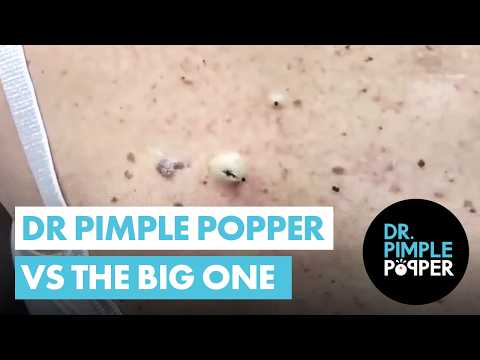 Dr Pimple Popper vs THE BIG ONE