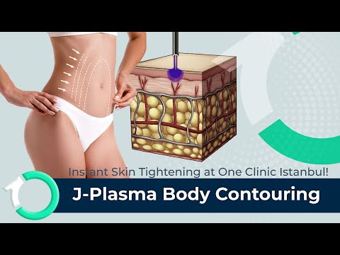 J-Plasma Renuvion Subdermal Skin Tightening - Surgical Procedure - One Clinic Patient Review Video