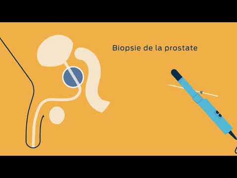 Diagnostic du cancer de la prostate | Société canadienne du cancer