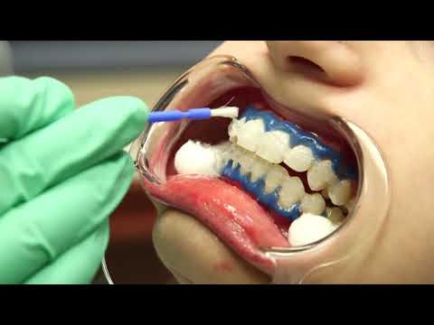 Shatkin iSmile Teeth Whitening