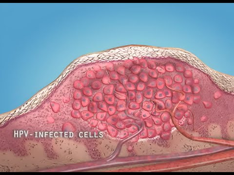 What are warts (HPV)? - 3D animation