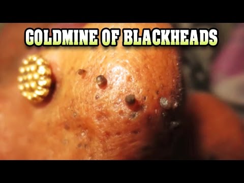 Goldmine of Blackheads 2017!  Dr. Vikram Biography 😂