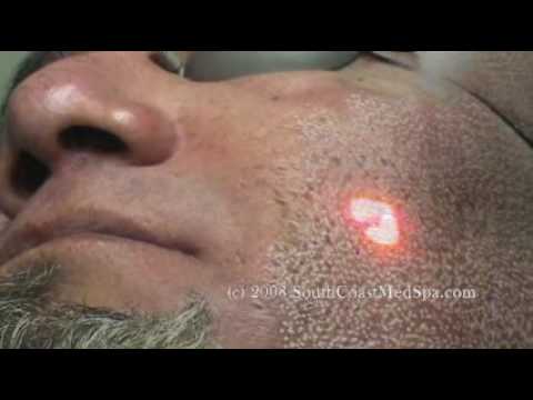 Laser Acne Scar Removal Treatment - Hispanic Patient