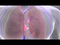 What Is Pulmonary Embolism