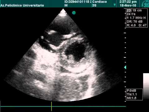 Severe Right Ventricle Dilatation In Echo Examination