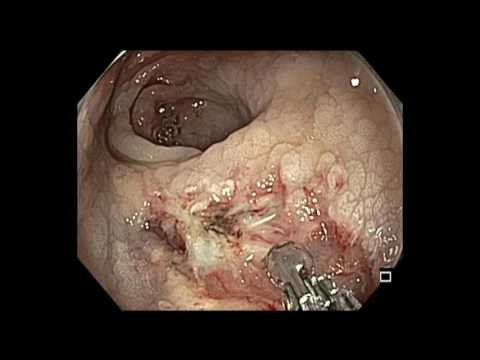 Colonoscopia - REM de recto, lesión adyacente a la anastomosis