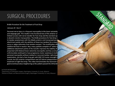 Bridle Procedure for the Treatment of Foot Drop - Standard (Feat. Dr. Johnson)