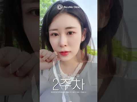 쌍꺼풀 재수술