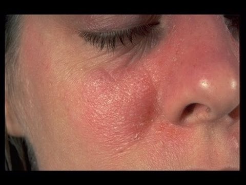 Wie die Schuppenflechte auf den Füssen der Beine zu behandeln Die Schuppenflechte ist beim Kind erschienen