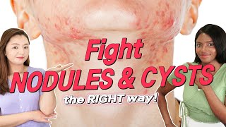 How To Get Rid of Nodular and Cystic Acne FOR GOOD : Root Time