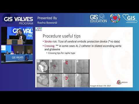 33  Rasha Bawardi   TAVI in Biscupid Aortic Valve, Optimum Technic & Procedural Refinement