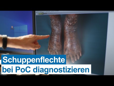 Schuppenflechte bei „People of Color“: Oft nicht leicht zu erkennen