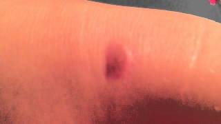 My scars+MY PHONE CRACKED!!