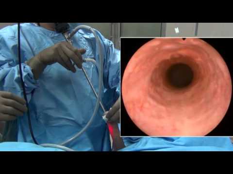 Cystoscopy: How to Advance the Cystoscope Through Urethra