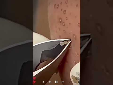 Skincare | Blackheads Removal #628 #tweezers skincare #blackheads blackheads