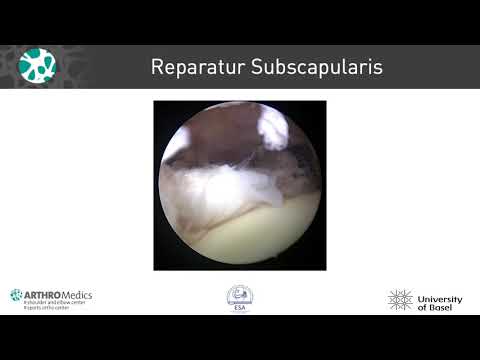 Die Rotatorenmanschette - Patienteninformation