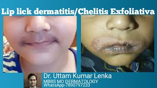 Lip lick chelitis/allergy/rashes/skin peeling around mouth/lips.(Hoth se chamdi kyun nikalta he?