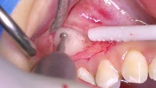 Dental Surgery: Small Cyst Removal by Oral Surgeon Dr Juraj Brozović Using Resorba Gentacoll Cones