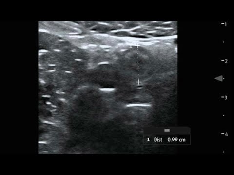 Adolescent with RLQ Pain:  Tip Appendicitis Dx by Dr. Akash Desai